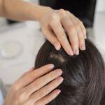 Ayurvedic hair fall and dandruff treatment